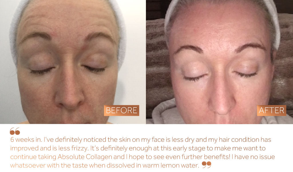 Before and after photo of dry skin on a woman’s face following 6 weeks of Absolute Collagen consumption. 