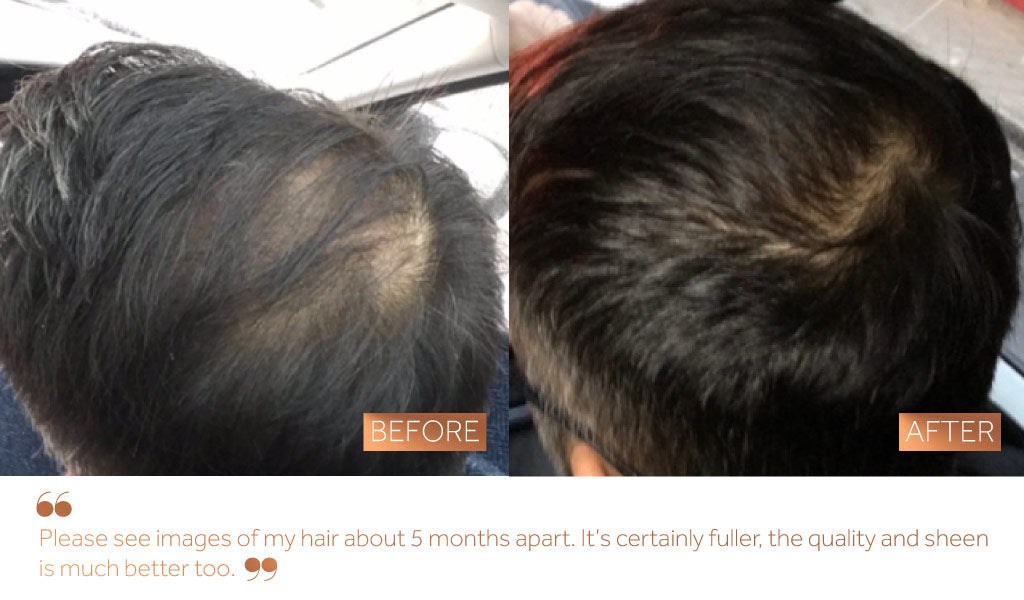 A before and after photo showing improvement to a man's itchy scalp 6 weeks of Absolute Collagen consumption.