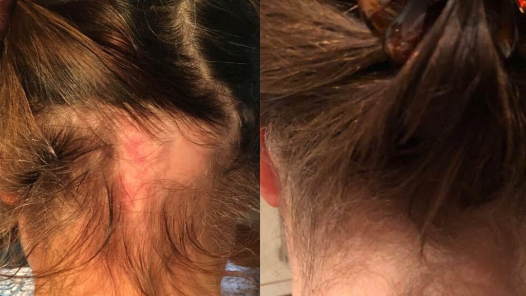 A before and after photo of a woman with brunette hair, in the first image she has sore skin and a bald patch and in the second image she has thick healthy hair