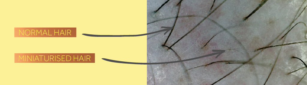 Close-up photo showing normal hair on a scalp alongside miniaturised hair