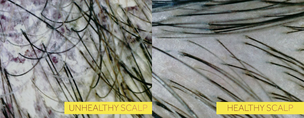 Two side by side photos, the first showing an unhealthy scalp with discolouration and the second showing a healthy scalp without