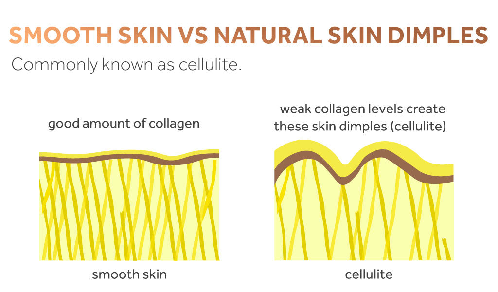 Graphic showing the structure of skin with cellulite vs the structure of skin without