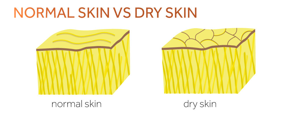 Graphic showing the difference between normal skin and dry skin