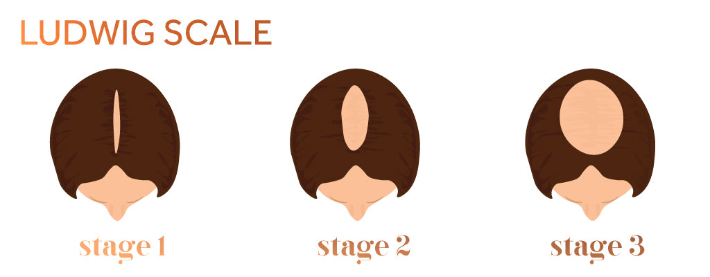 Graphic showing the stages of female pattern baldness according to the Ludwig Scale