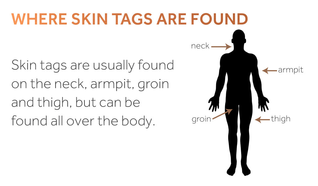 Image of a human body with labelled areas where skin tags are commonly found