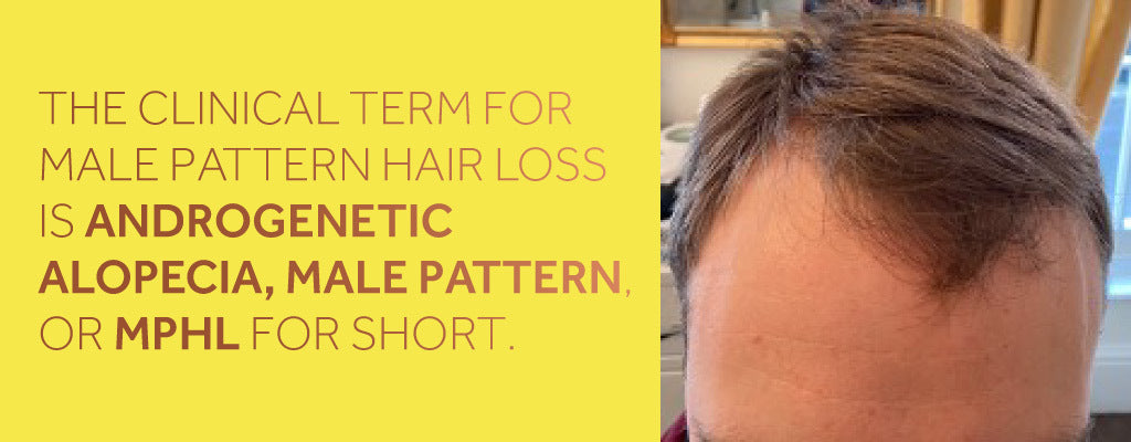 Close up photo showing a white man with brown hair who is suffering from male pattern hair loss, alongside a description of the medical terms for this condition