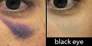 Black Eye Concealed