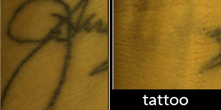 Tattoo Cover-Up