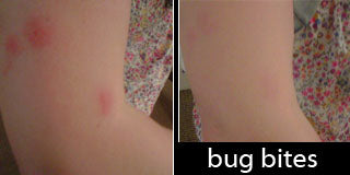 Bug Bites Concealed