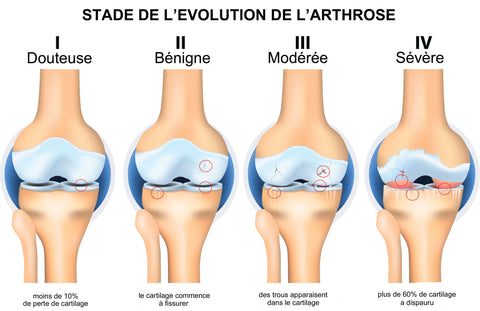 Arthrose du genou pourquoi porter une genouillère ? - ESPACE CHAUCHARD