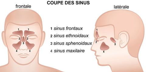 Infection des sinus (sinusite chronique)