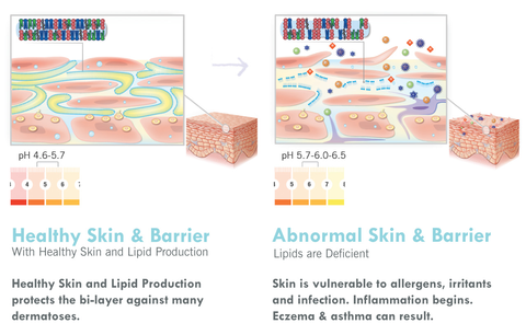 Steroids use for eczema