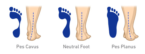 Foot Misalignment Examples