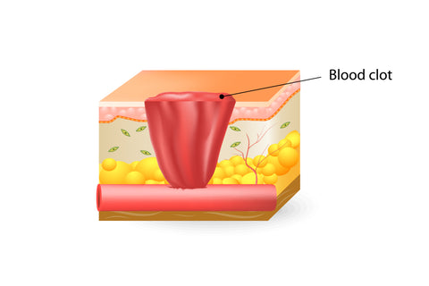 Diagram of a blood clot