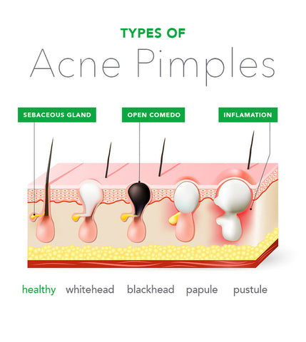 What Type of Acne Do You Have? Types of Acne Explained – BioClarity