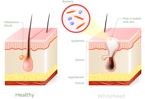 what type of acne do I have? Whiteheads