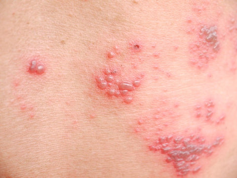 Picture of Shingles