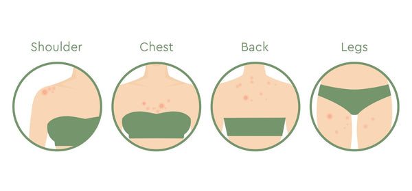 acne can appear on shoulders, chest, back, and legs