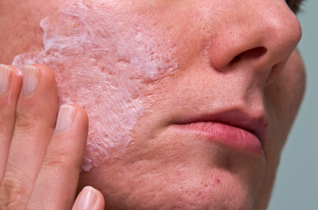 How To Get Rid of Acne Treatments –