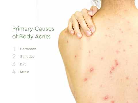 primary causes of body acne