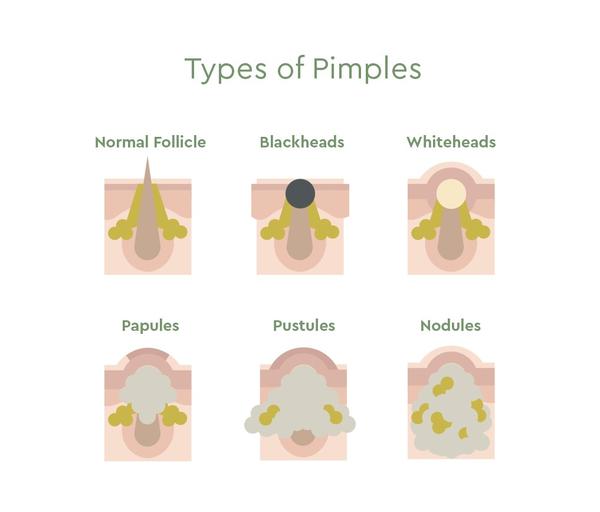 different types of pimples diagram
