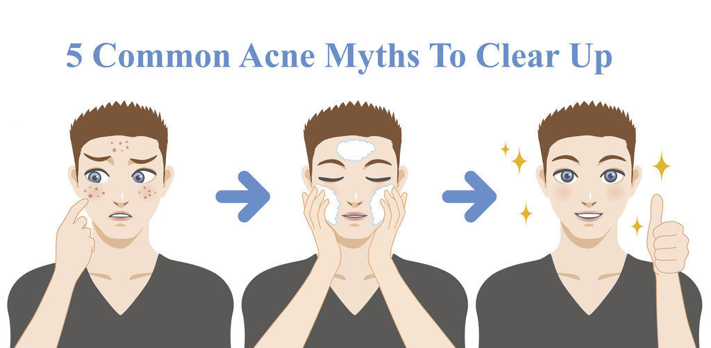 5 Common Acne Myths to clear up