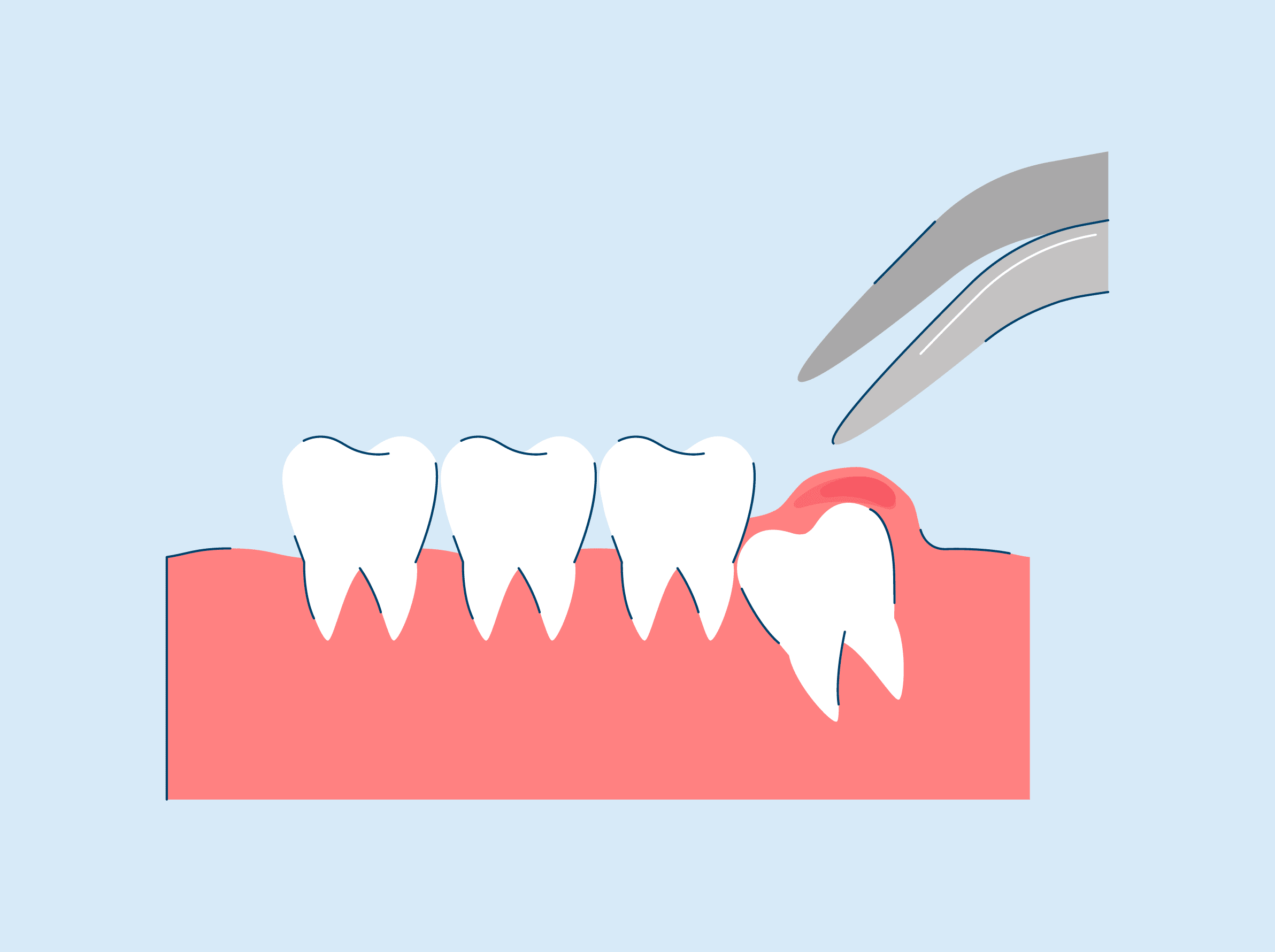 emergency-wisdom-tooth-removal-process