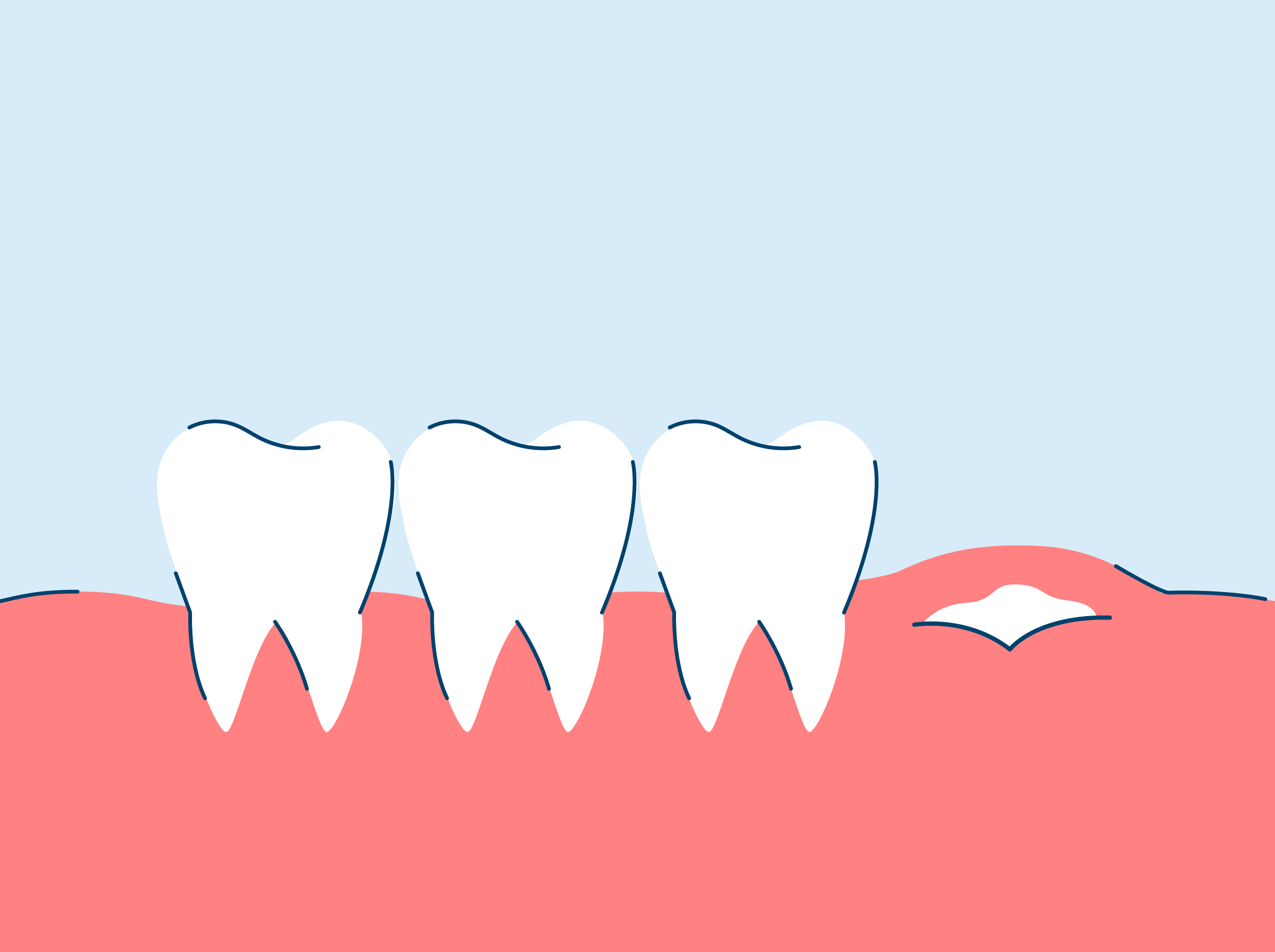 wisdom-teeth-symptoms-when-they-re-growing-in