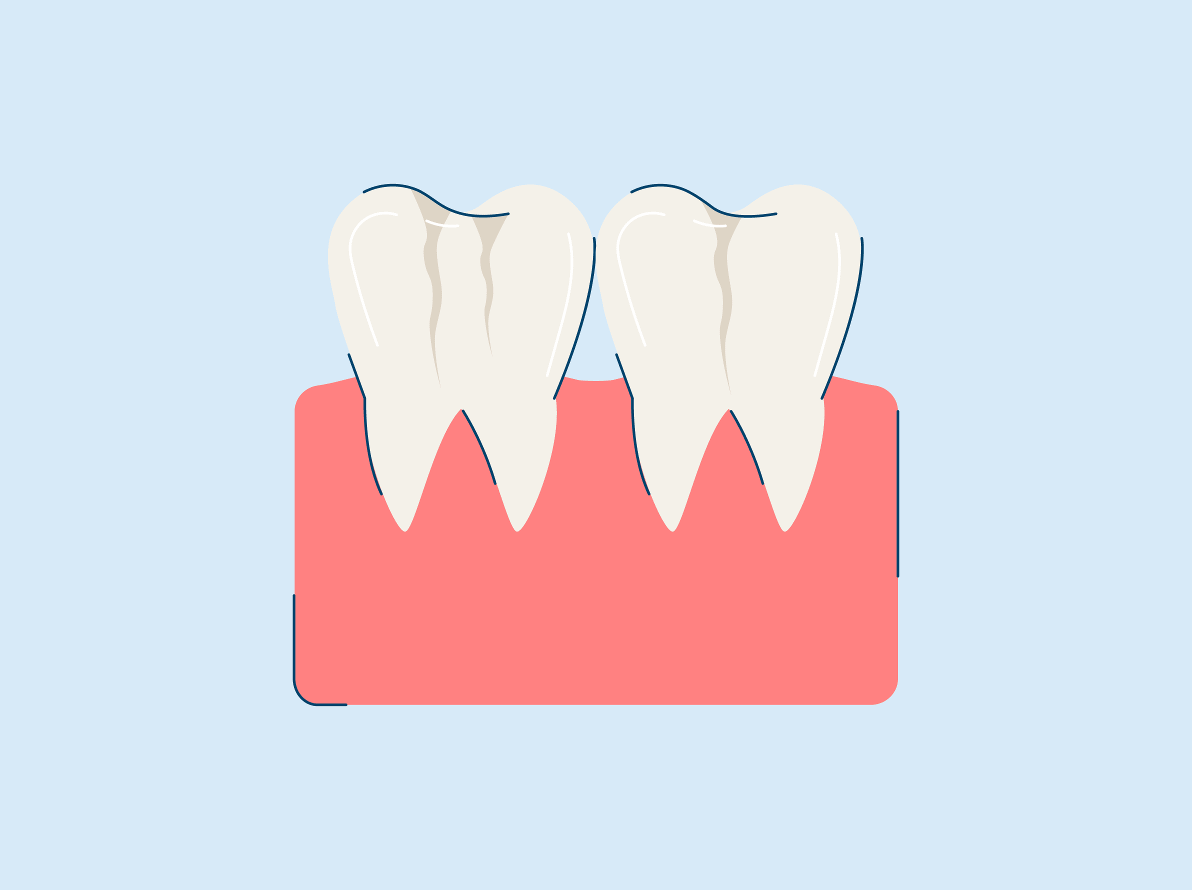 Everything You Need to Know about Craze Lines on Front Teeth, Dentist in  Roswell, GA, TruCare Dentistry Roswell