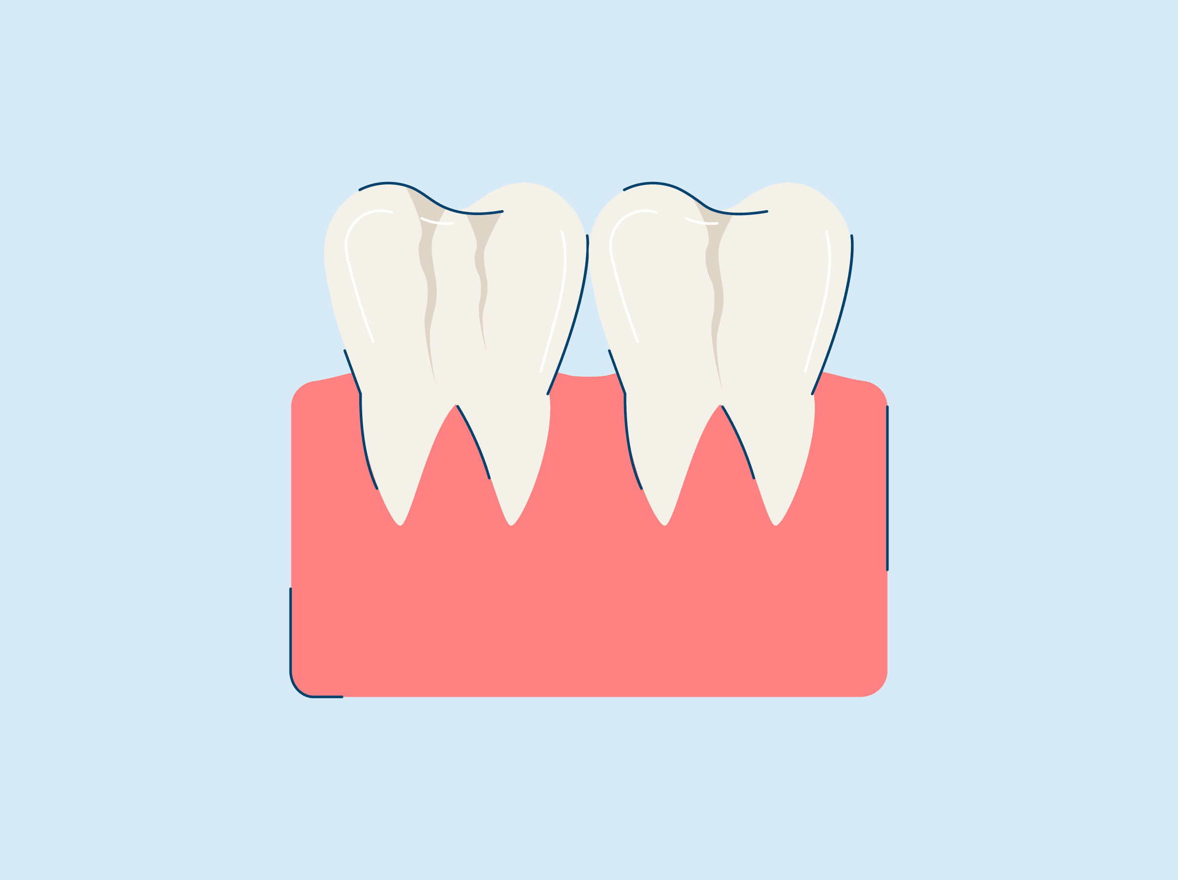 What are Craze Lines? Causes and Treatment