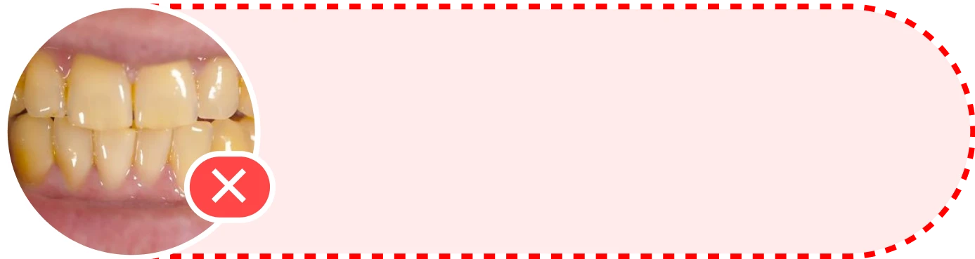 Picture showing discolored teeth, marked with a red cross symbol.