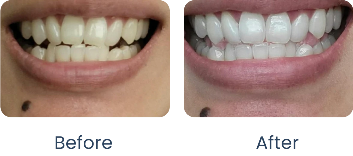 Before and after images showing teeth whitening results.