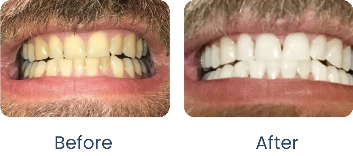 Before and after teeth whitening comparison.