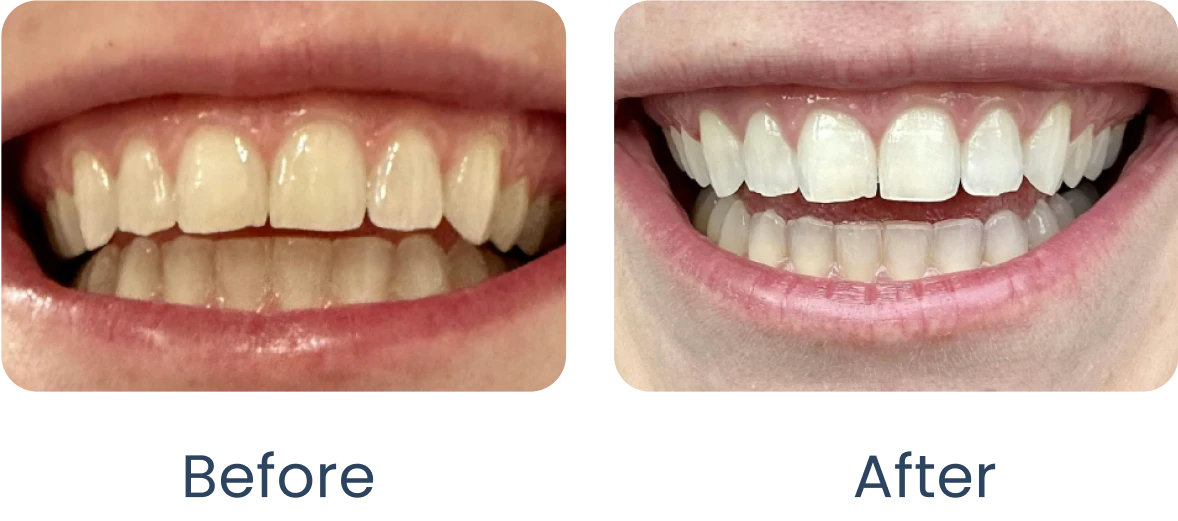 Comparison of teeth whitening results: before and after treatment.