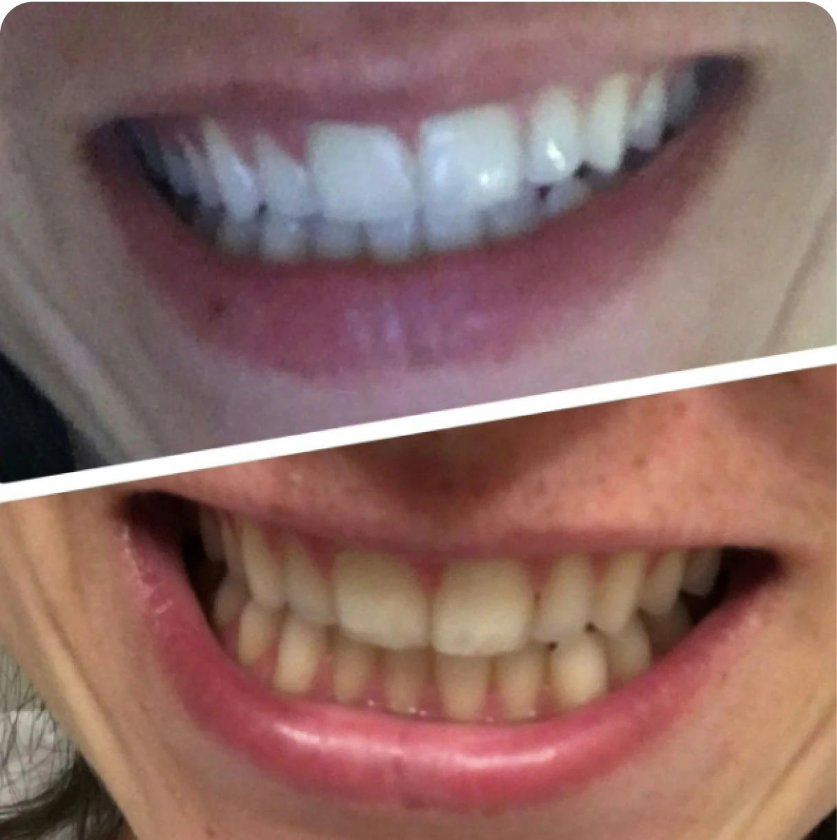 Before and after comparison of a person's teeth, showing dental improvement.