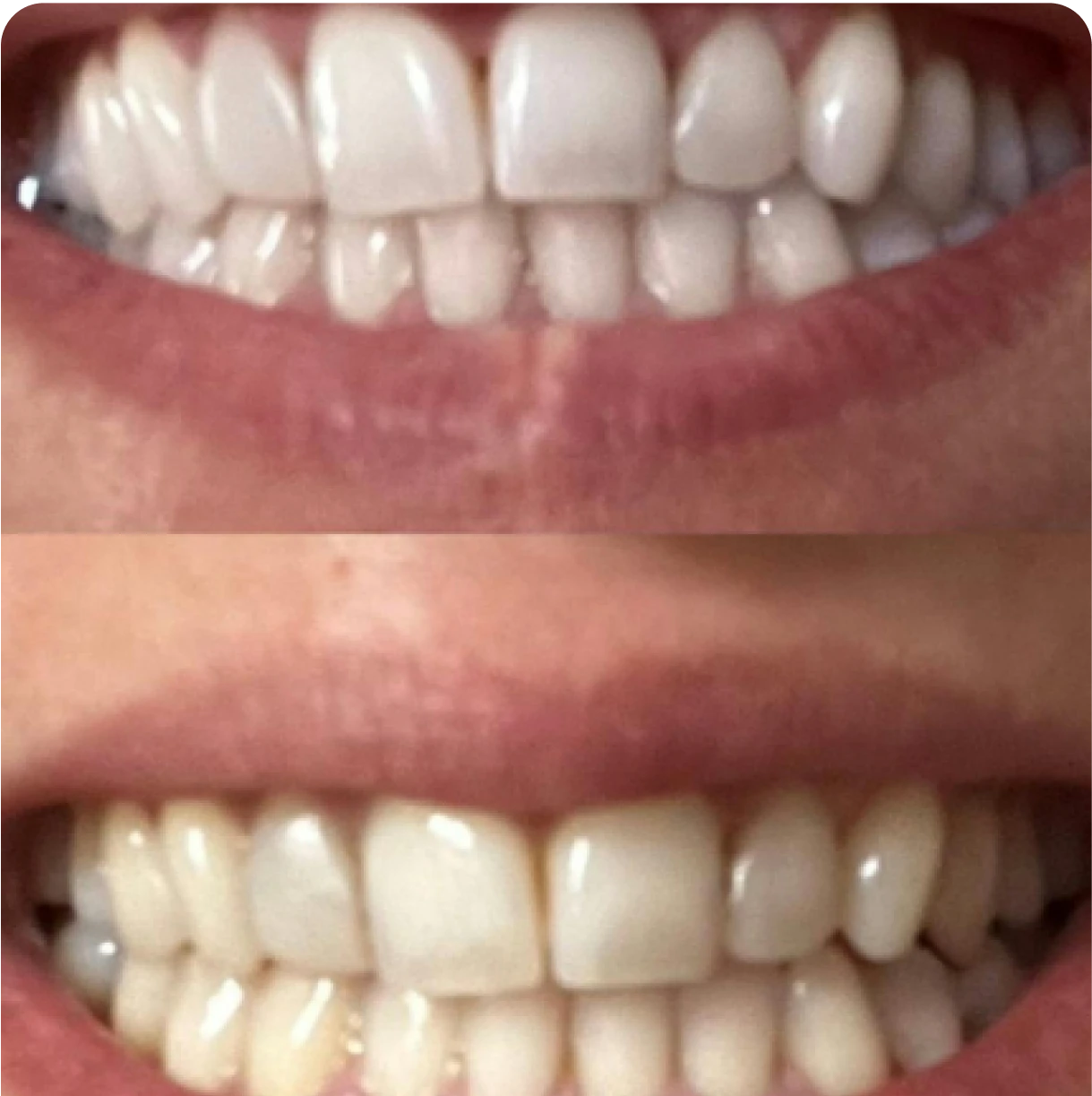 Before and after image of teeth whitening treatment.