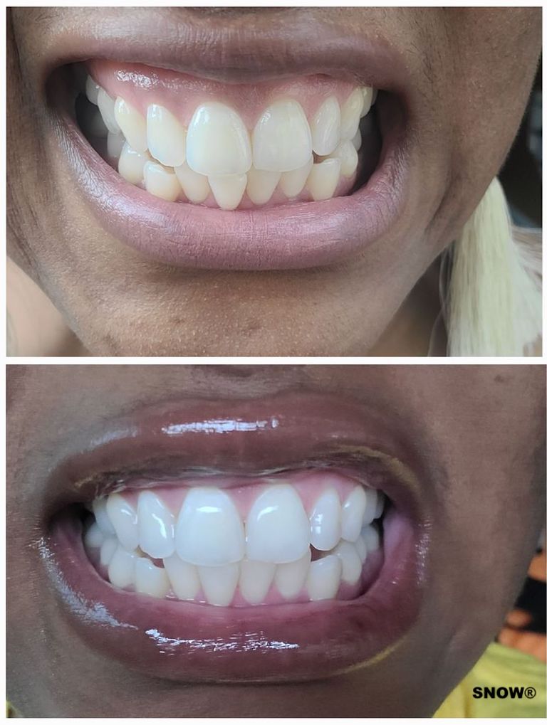 salon operatør Tag et bad Teeth Whitening Strips | SNOW®