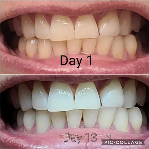 brush on teeth whitening