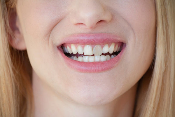 can brown teeth become white