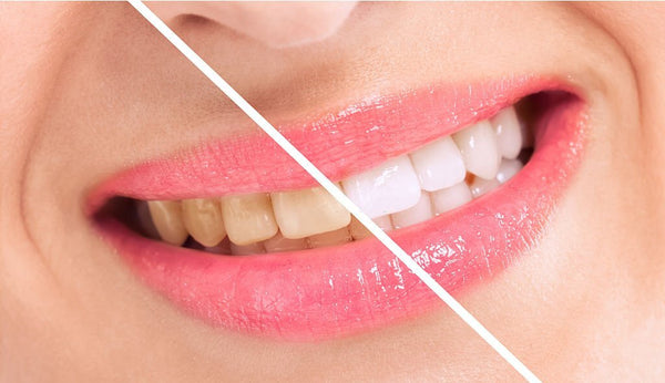 clorox bleach to whiten teeth