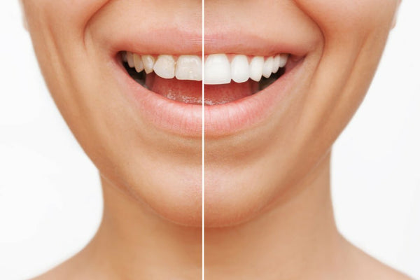 does teeth whitening harm veneers