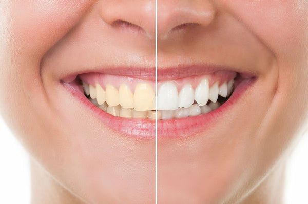 how to fix your stained teeth
