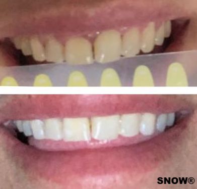 Voetganger optioneel Kruis aan Limited Edition Wireless Teeth Whitening System by SNOW®