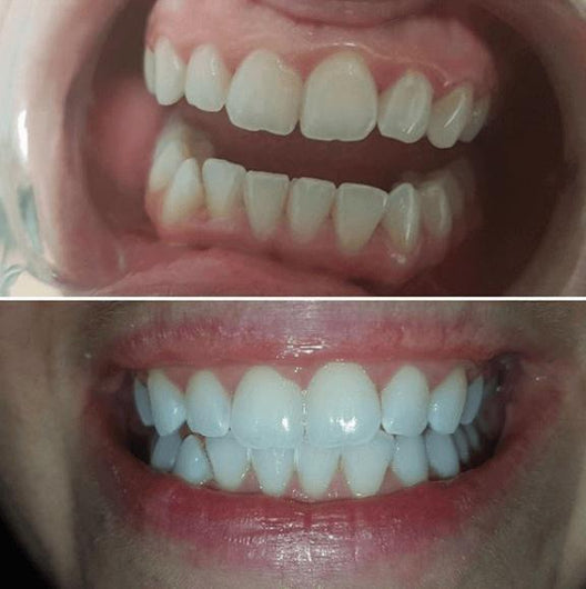 Special Offer - SNOW Teeth Whitening™ System