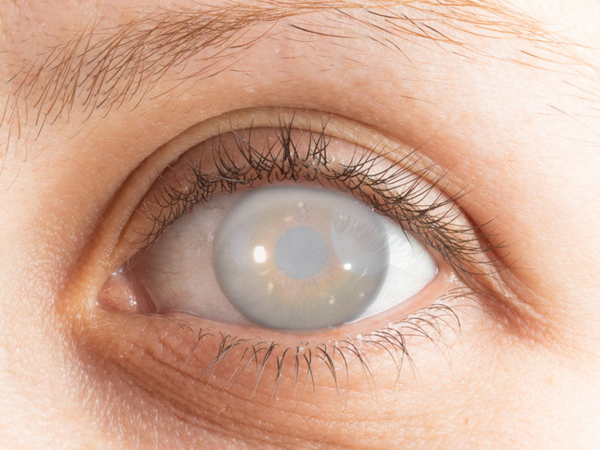 Cataracts: take care of your eyesight and don't let it advance