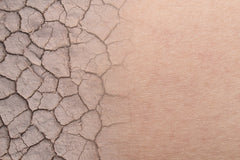 dehydrated skin