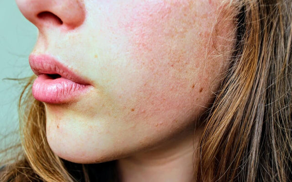 Close up of a face with irritated skin, which can be caused by common soap ingredients such as parabens