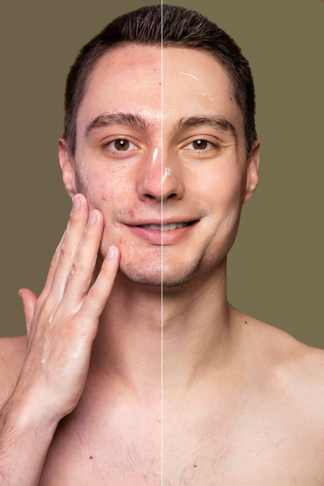 Man with sensitive skin applying a skincare product - before and after