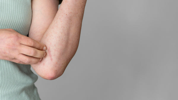 Closeup of an arm with dermatitis (eczema)