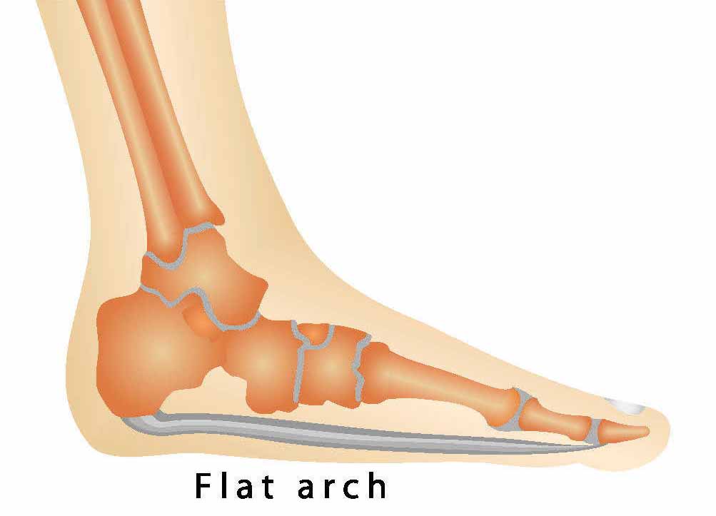 Flat Feet Overpronation Causes, Treatment and Prevention